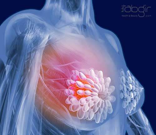 مراحل سرطان پستان التهابی چیست ؟