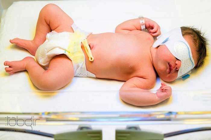 بهترین راه درمان زردی نوزادان