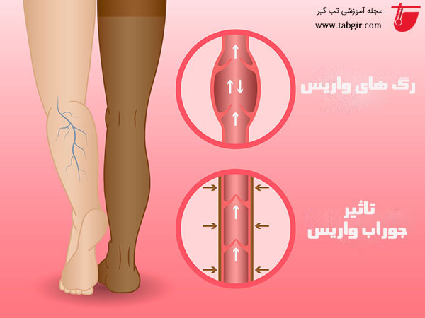 Do Compression Stockings Help to Treat Varicose Veins?