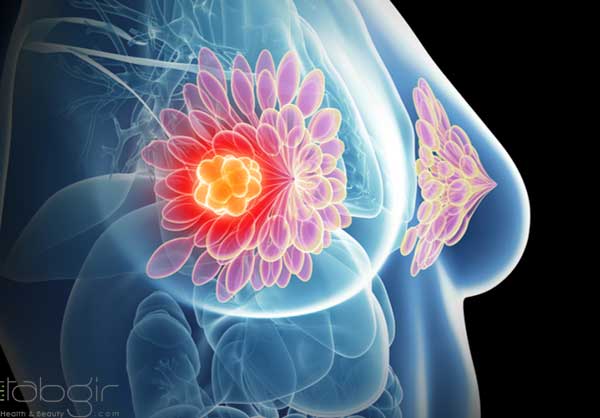 تصاویر سرطان سینه