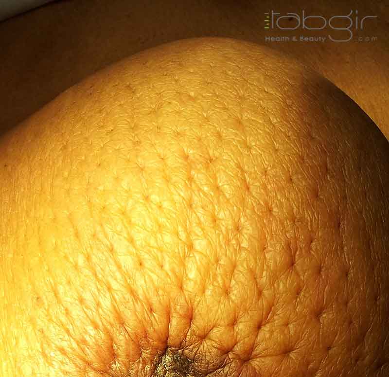 پوست پرتقالی در سرطان سینه
