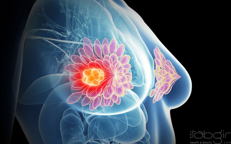 مراحل سرطان پستان