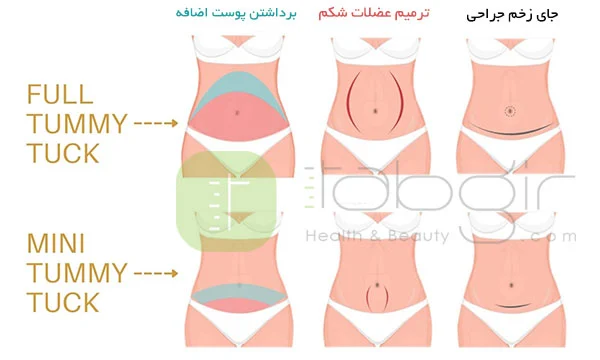 تفاوت ابدومینوپلاستی با مینی ابدو