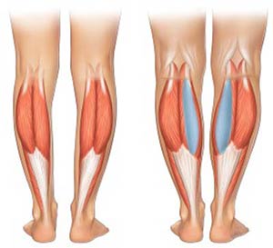 پروتز ساق پا در عمل زیبایی بدن