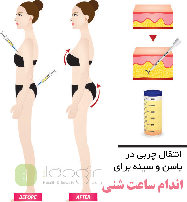 انتقال چربی در لیپوماتیک ساعت شنی